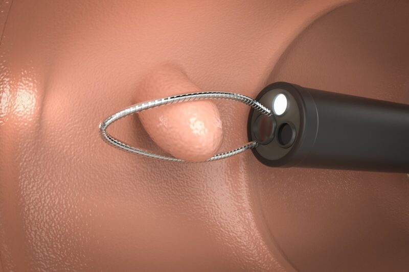 大腸ポリープ切除