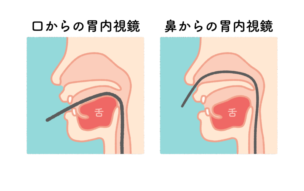経鼻内視鏡検査と経口内視鏡検査を選択可能